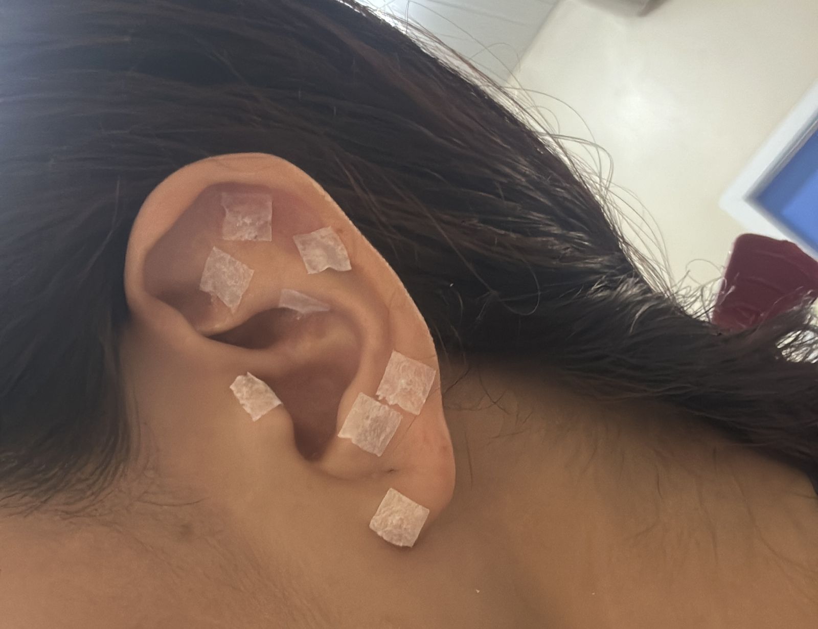 Policlínica_Coronel_Mota_oferece_serviço_de_auriculoterapia_para_pacientes_Ascom_Sesau_4.jpeg